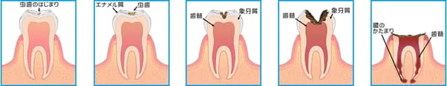 虫歯の進行イメージ